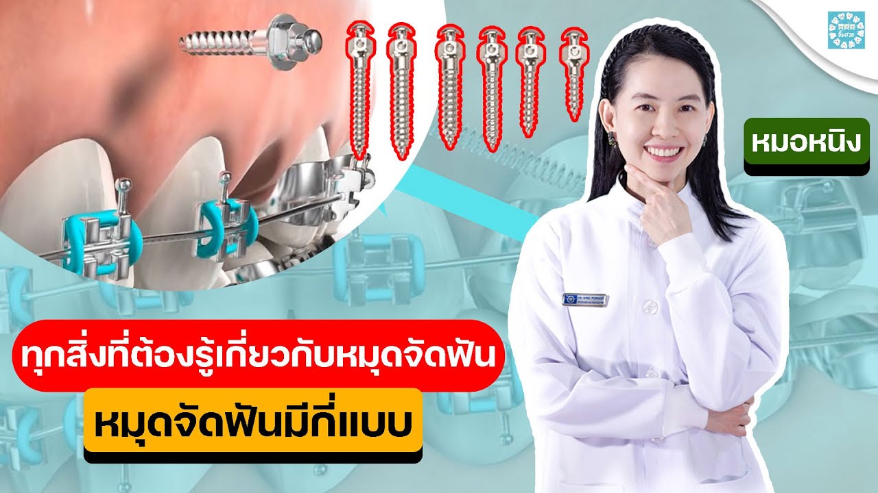 หมุดจัดฟันมีกี่แบบ ทุกสิ่งที่ต้องรู้เกี่ยวกับหมุดจัดฟัน