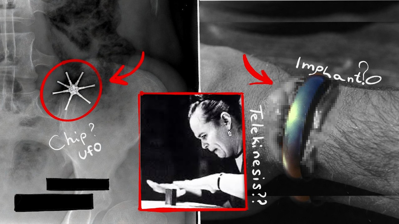 MENSCHEN MIT Alien-Implantaten &ndash; 3 Dokumentierte Unerkl&auml;rliche Geschichten