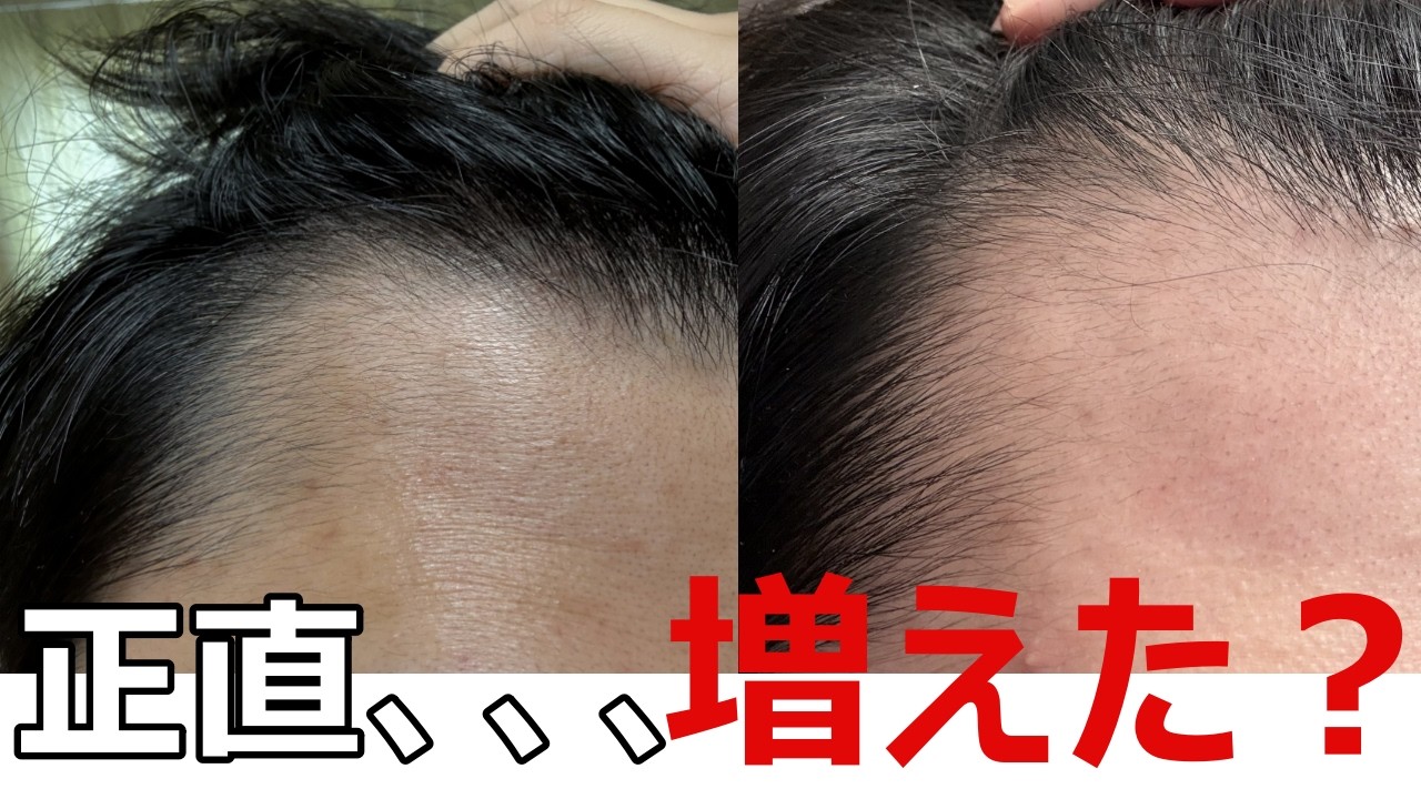 AGA治療4ヶ月目｜正直…増えた？2→4ヶ月のリアル経過
