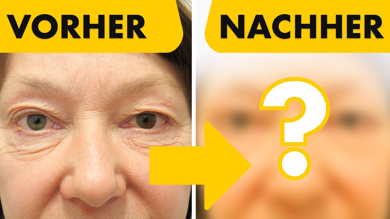 Ober-und Unterlidstraffung bei 59-jähriger Patientin | Vergleich vor und nach der OP | Dr. Jungwirth
