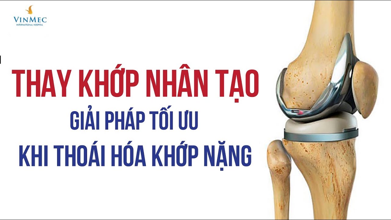 Thay khớp nhân tạo - Giải pháp tối ưu khi thoái hóa khớp nặng