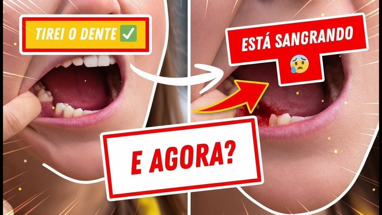 QUAIS CUIDADOS DEVO TER APÓS EXTRAIR O DENTE? | PÓS CIRURGIAS
