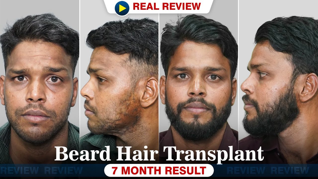 Burnt Case Beard Transplant Ahmedabad | 2211 Grafts | Hairfree & Hairgrow | Dr Richa Sanmukhani