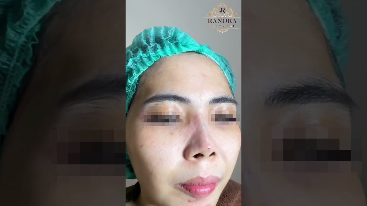 Before After Thread Lift Hidung