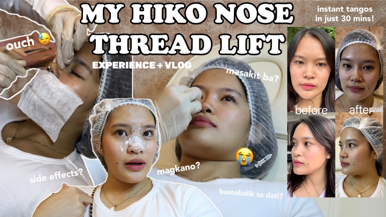 HIKO NOSE THREAD LIFT VLOG 💉👃🏻 INSTANT TANGOS IN JUST 30 MINUTES | IS IT WORTH IT? HOW MUCH? 💸