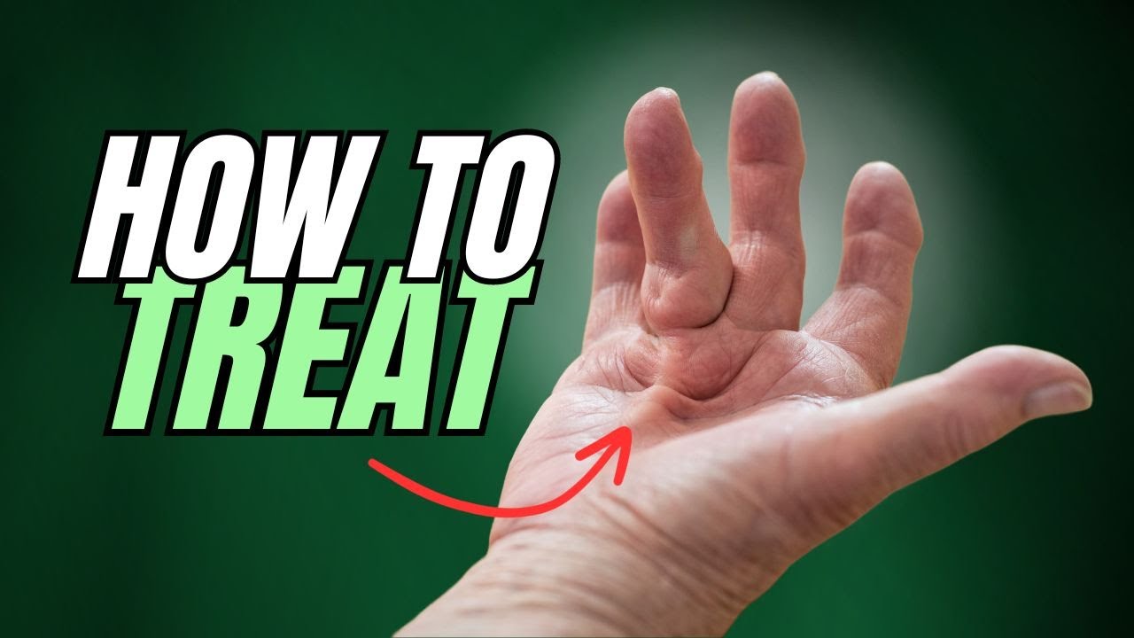 Dupuytren's Contracture (Starts as Lump on Hand) How to Treat