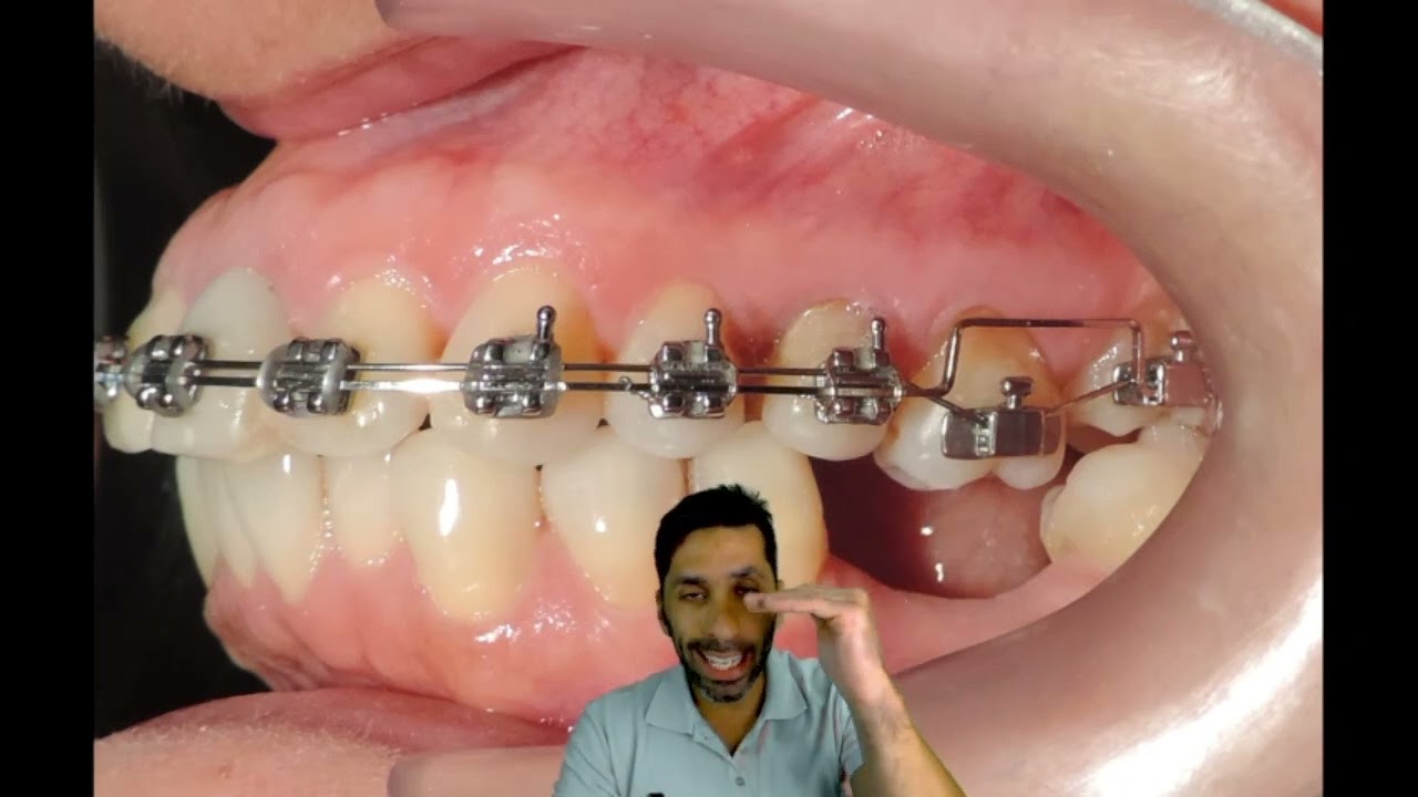 Intrusión de molar con el Bracket Doble Slot