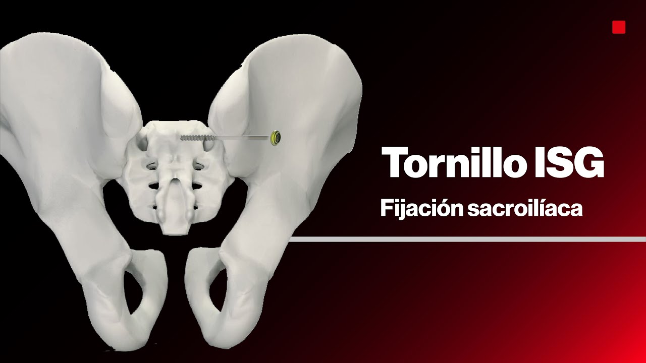 Tornillo ISG® | Fijación Sacroilíaca