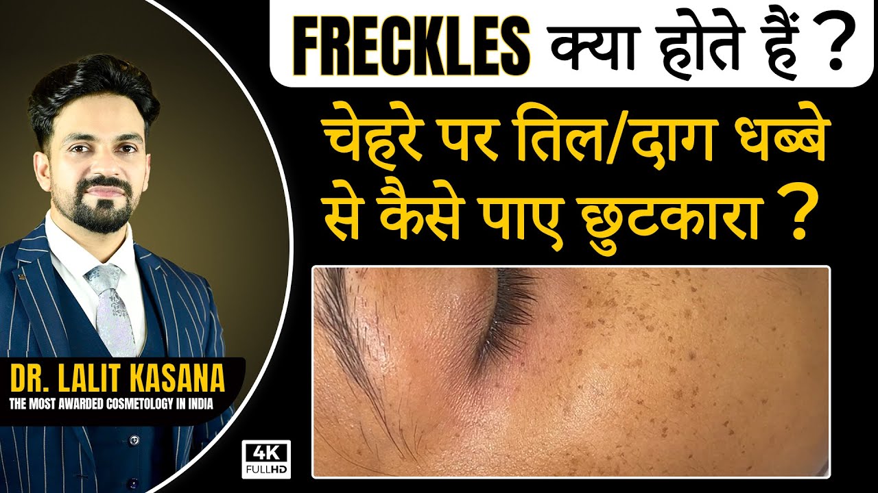 Freckles क्या होता हैं ? चेहरे पर तिल दाग धब्बे से कैसे पाए छुटकारा ?  at Dr Kasana Clinic