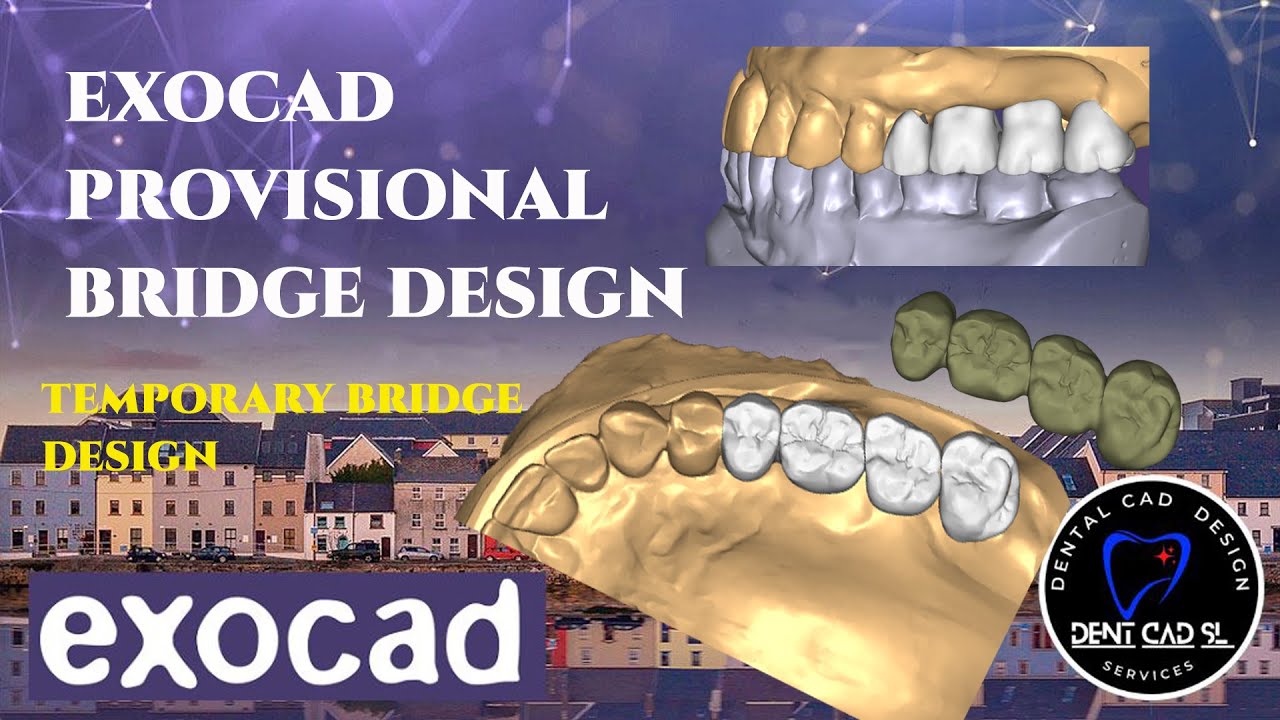 exocad provisional bridge design
