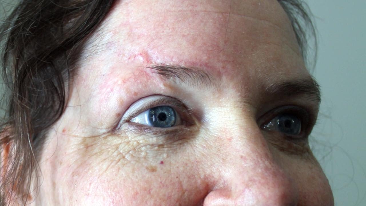 Help for Woman's Eyebrow Replacement Due to Face Scar