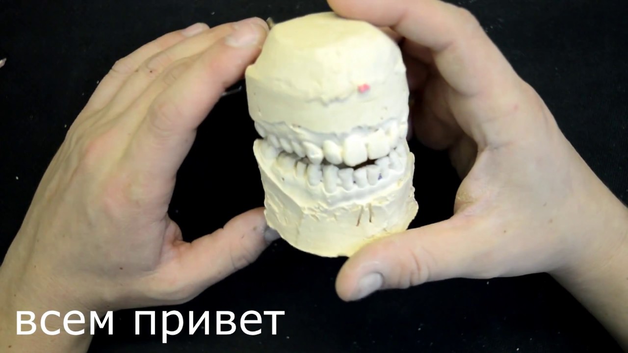 цельнометаллическая штампованная коронка