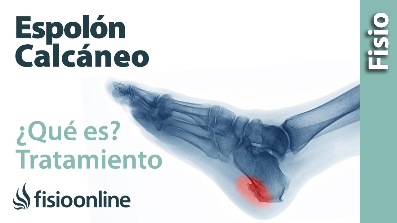 Espol&oacute;n calc&aacute;neo dolor en el tal&oacute;n - Qu&eacute; es, causas, s&iacute;ntomas y tratamiento