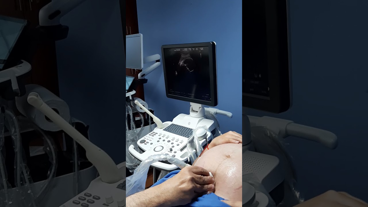 De nuevo con el R7, paso a paso en el 2D, 3D, 4D y Doppler en una ecografía Obstétrica.