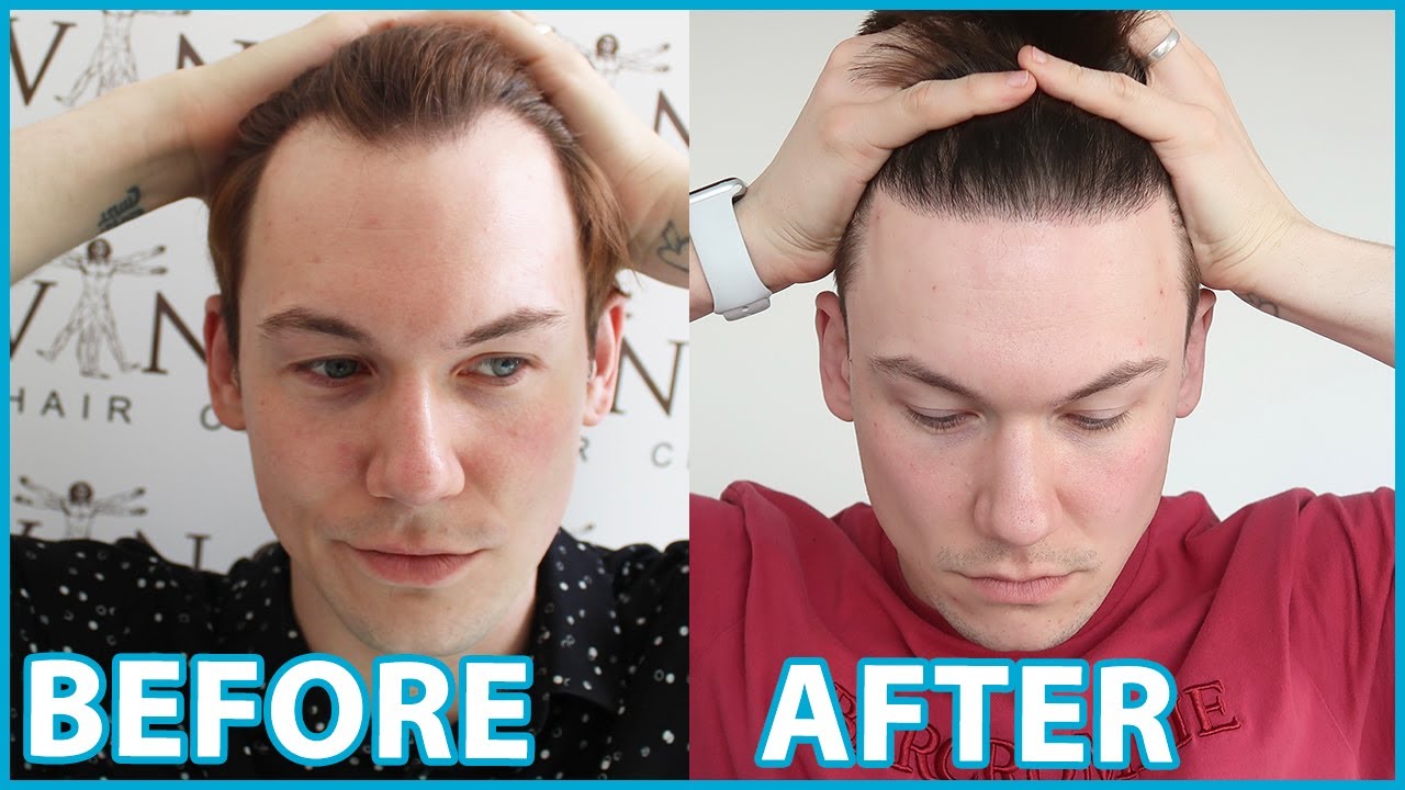 FUE Hair Transplant | Month 9 | Surgery, Growth, Before & After Hairline | Progress Update