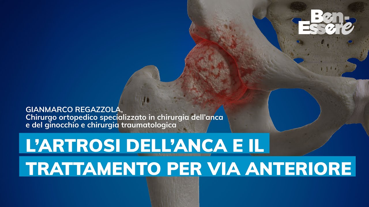 L’ARTROSI DELL’ANCA E IL TRATTAMENTO PER VIA ANTERIORE