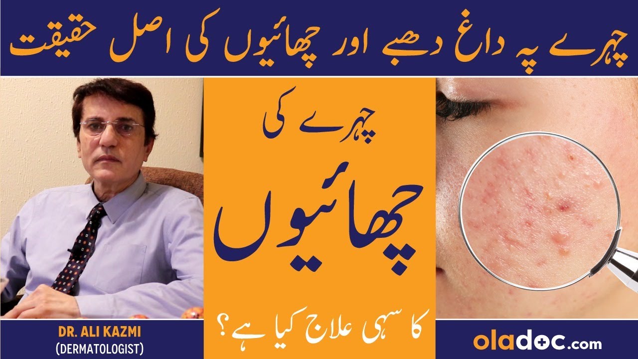 Chehre Ki Chaiyan Khatam Karne Ka Tarika - Pigmentation Melasma Treatment - Dagh Dhabo Ka Sahi Ilaj