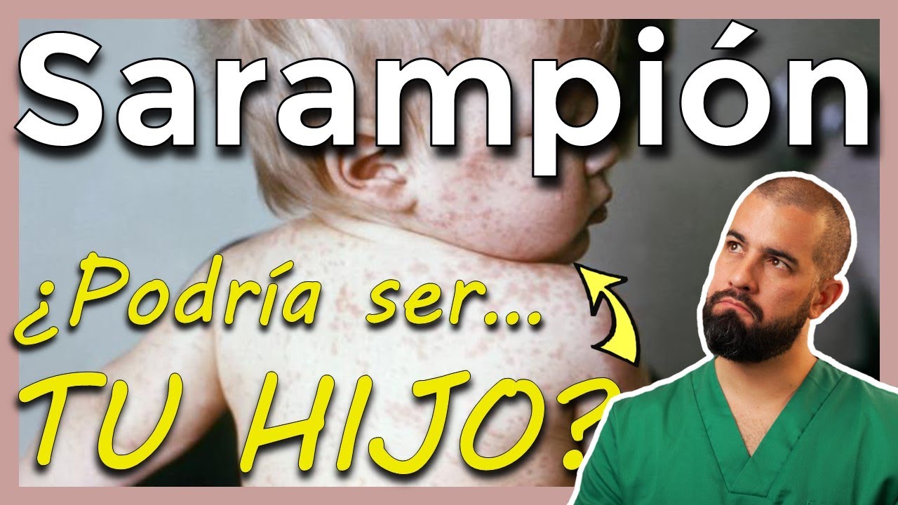 SARAMPIÓN síntomas, tratamiento y CÓMO prevenirlo
