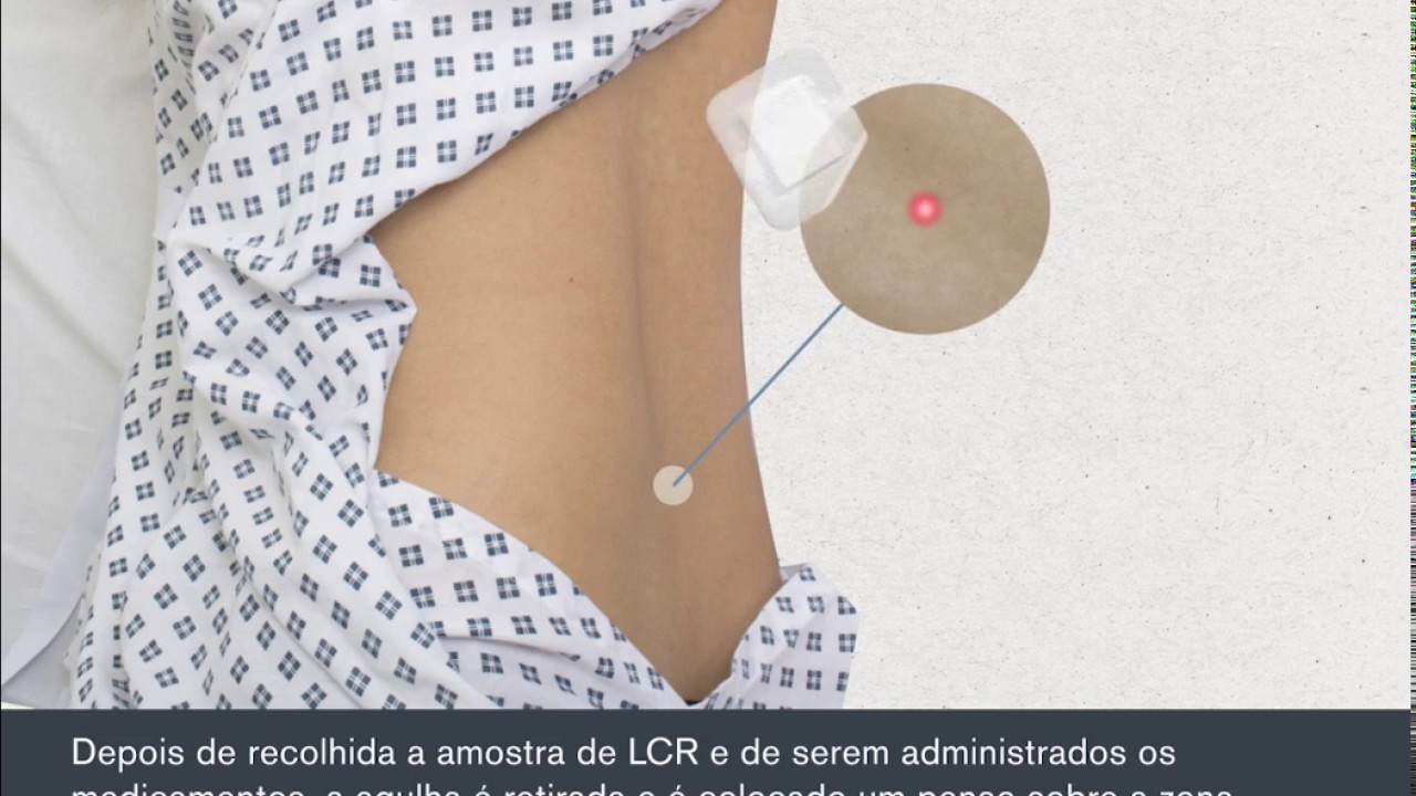 Lumbar Puncture (Portuguese) / Pun&ccedil;&atilde;o lombar