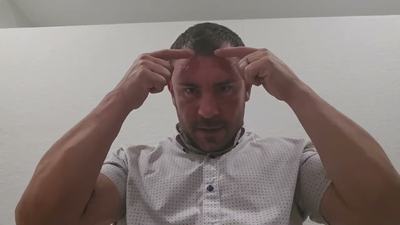 Month 2 Post Hair Transplant Update-3700 Grafts