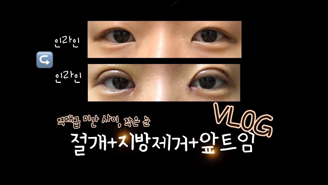 [쌍수 브이로그] 절개,지방제거,앞트임 브이로그!/ 수술 직 후부터 실밥 제거일까지 자세하게👀/ 성형 브이로그
