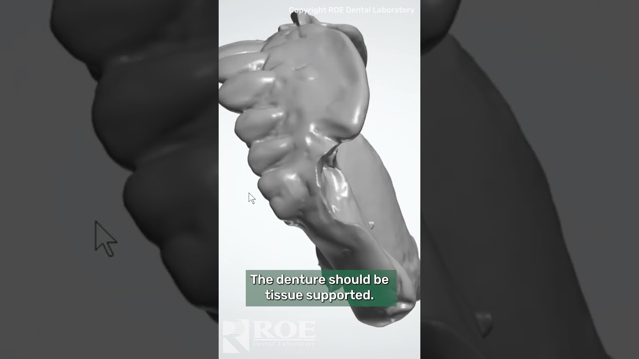 Quick Overview of Grammetry Edentulous Case Records #shorts