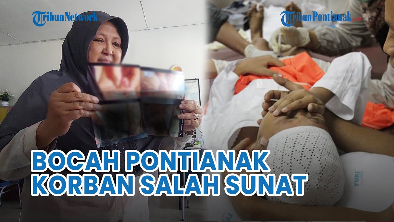 🔴 Diduga Salah Prosedur Saat Sunat, Bocah di Pontianak Harus Operasi Berkali - Kali
