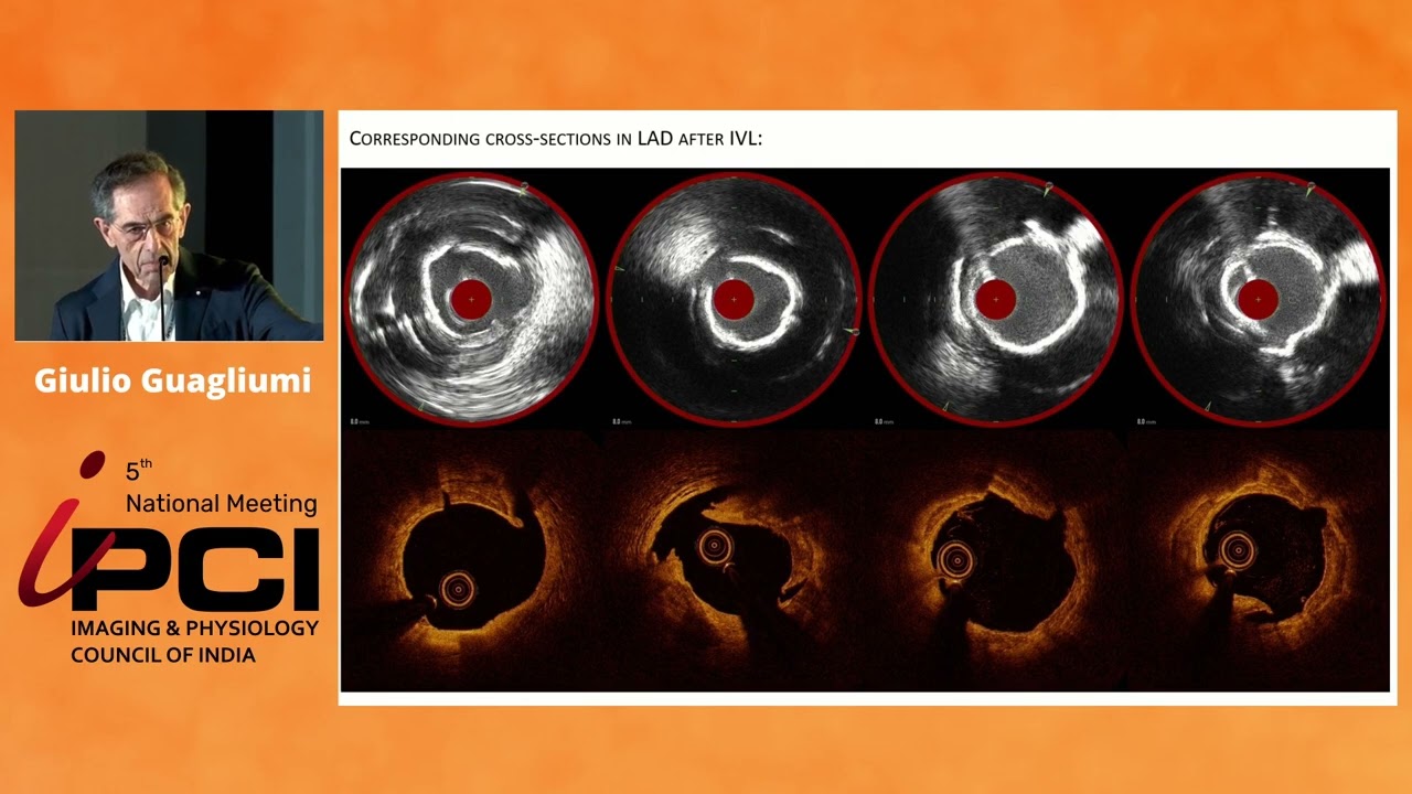 DR.GIULIO GUAGLIUMI- IMAGING IN CALCIFIED LESIONS