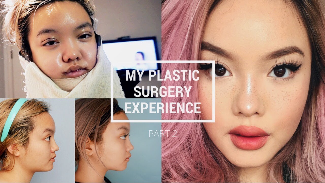 PLASTIC SURGERY IN KOREA: PT. 2 [RECOVERY + RESULTS]