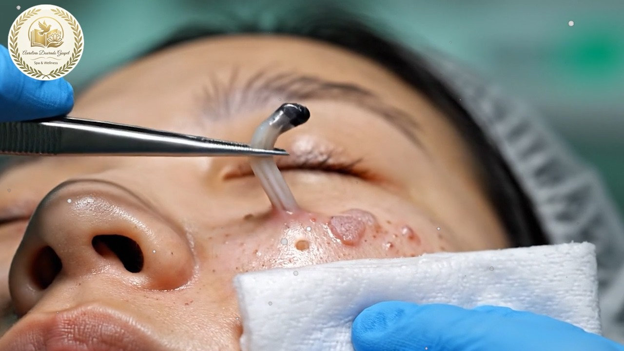 [ASMR] Dr. Lee&rsquo;s deep blackhead extraction ✨ spa-style facial for smooth, skin ASMR forget rhythm