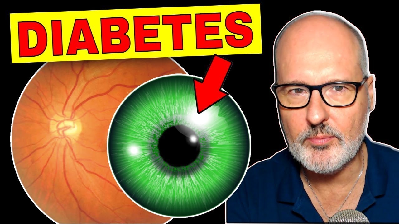 10 SÍNTOMAS  OCULARES de AZÚCAR ALTO (DIABETES)