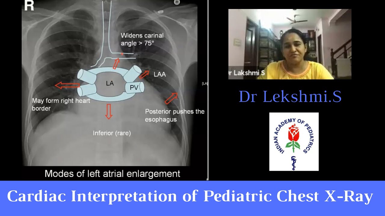 Chest X-ray- Focusing the CVS - Cardiac Interpretation of Pediatric Chest X-Ray -Pediatric Webinar