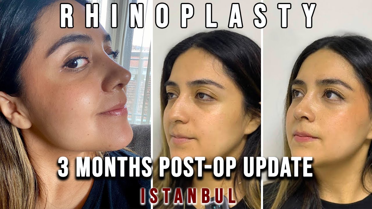 Rhinoplasty in Istanbul | 3 Months After the Surgery