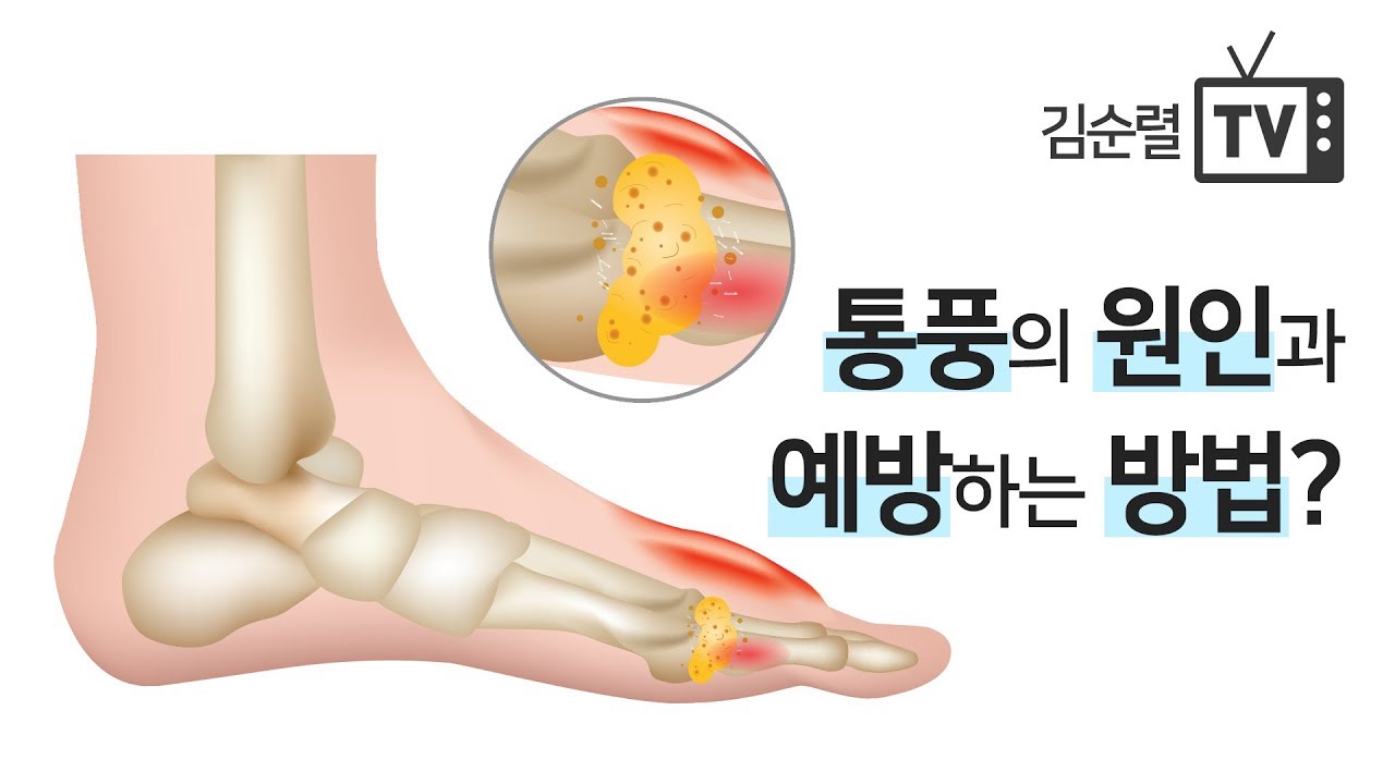 통풍의 원인과 예방법 [한의학박사 김순렬]