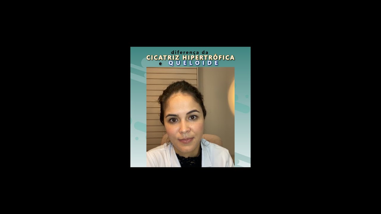 DIFEREN&Ccedil;A DA CICATRIZ HIPERTR&Oacute;FICA EQUELOIDE