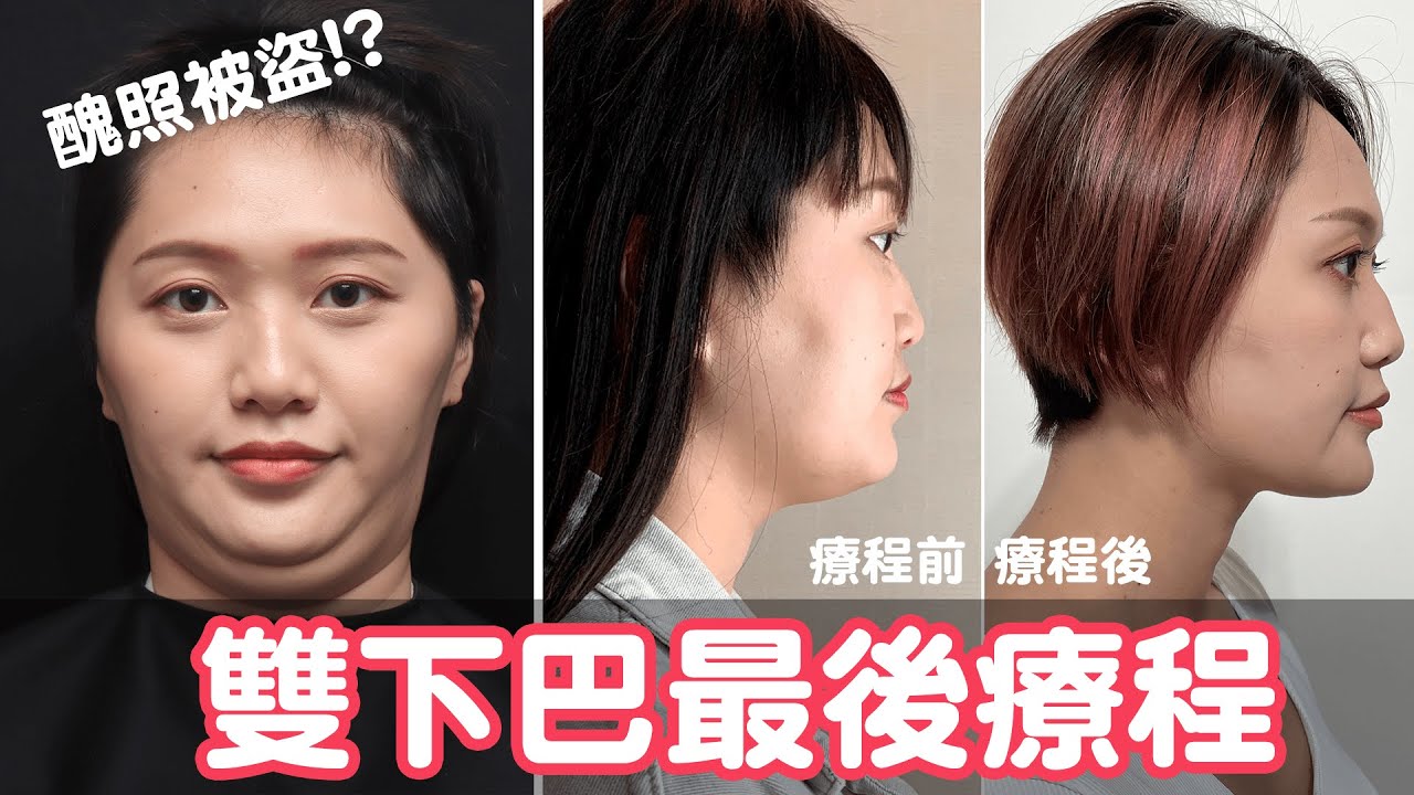 【麻希】雙下巴療程最後階段，超醜對比照被盜？倍克脂分享
