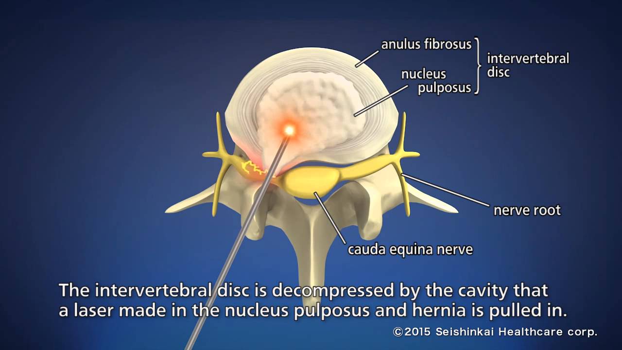 Treatment of lower back pain (Hybrid Laser Treatment)