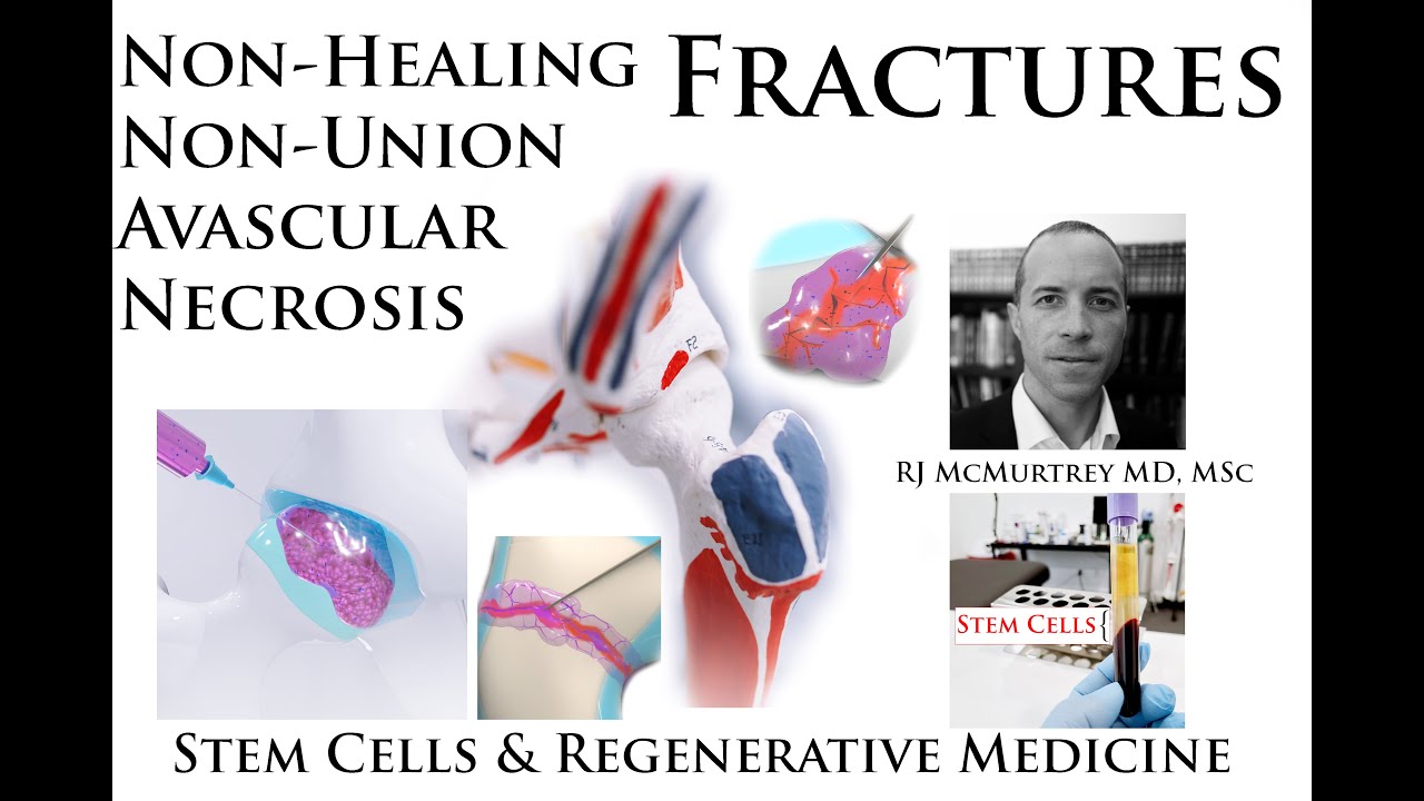 Non-Union Bone Fracture Defects: New Minimally-Invasive Regenerative Intervention Treatment Options