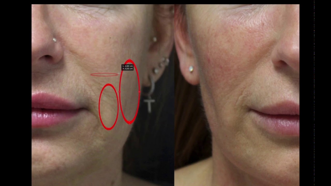Bichectomia Frontale piu' lifting - Dott. Antonio Distefano