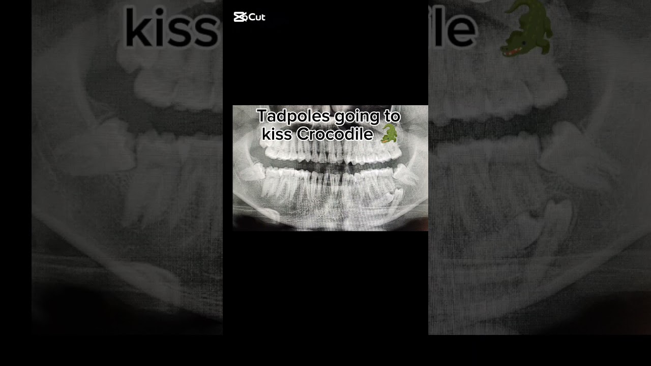 Ectopic Teeth: Supernumerary Teeth | Tadpoles Teeth kissing a Crocodile 🐊#dentist #dentalartistry
