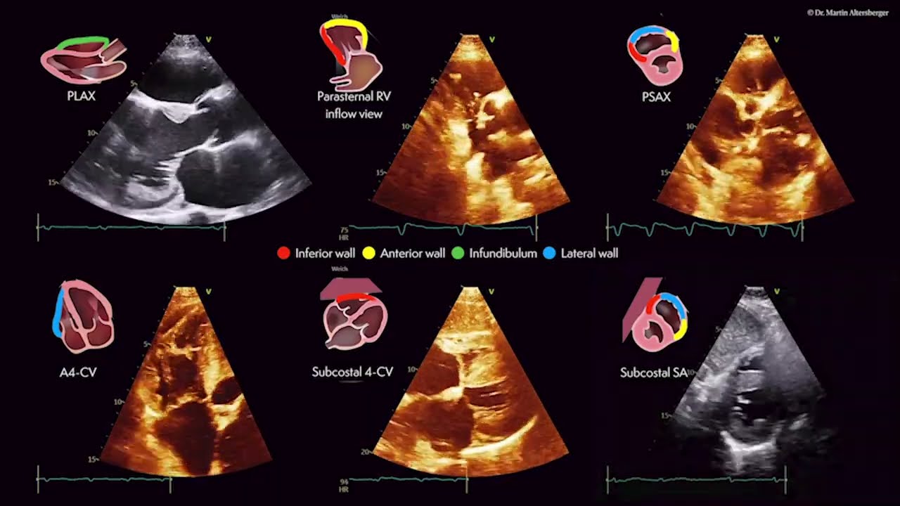 〖Echocardiography〗 The right ventricle - full version 💘