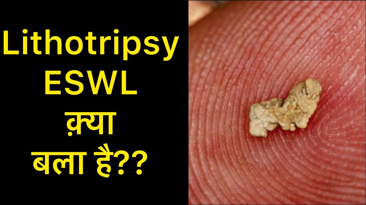 Lithotripsy Treatment for Kidney Stones in Hindi | Lithotripsy Side effects | ESWL Treatment