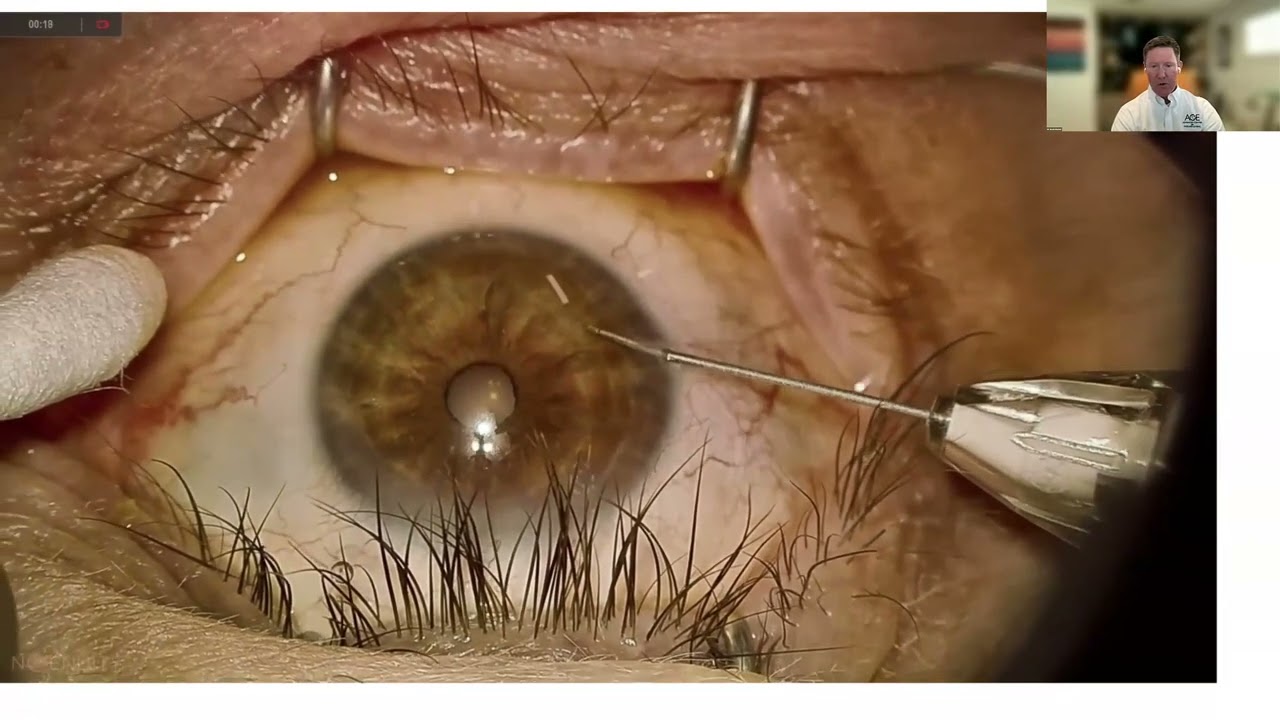 Lecture: MIGS and Evolving Non-traditional Glaucoma Treatment Options For Anterior Segment Surgeon