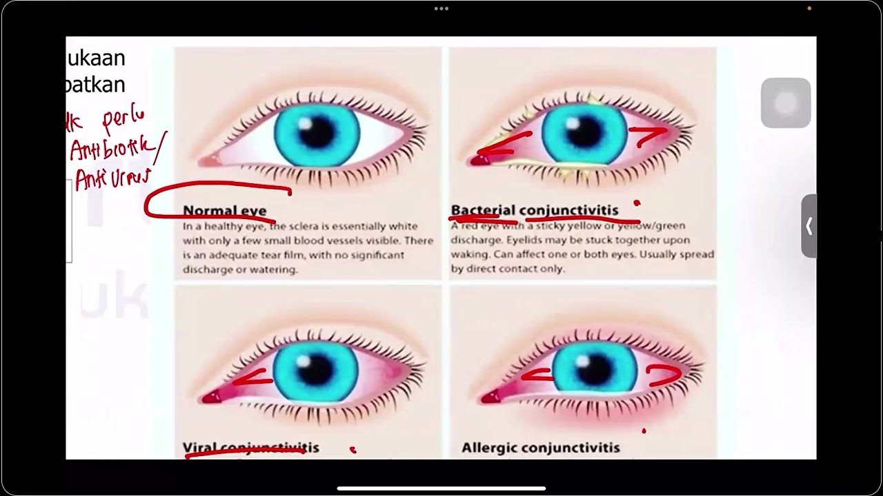 Agustus P3 - Penyakit Infeksi Gonore dan HIV, THT Mata, dan Kulit