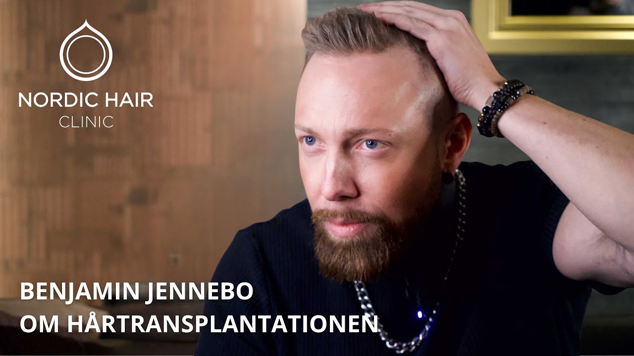 Benjamin Jennebo från Smash Into Pieces om hårtransplantationen | Nordic Hair