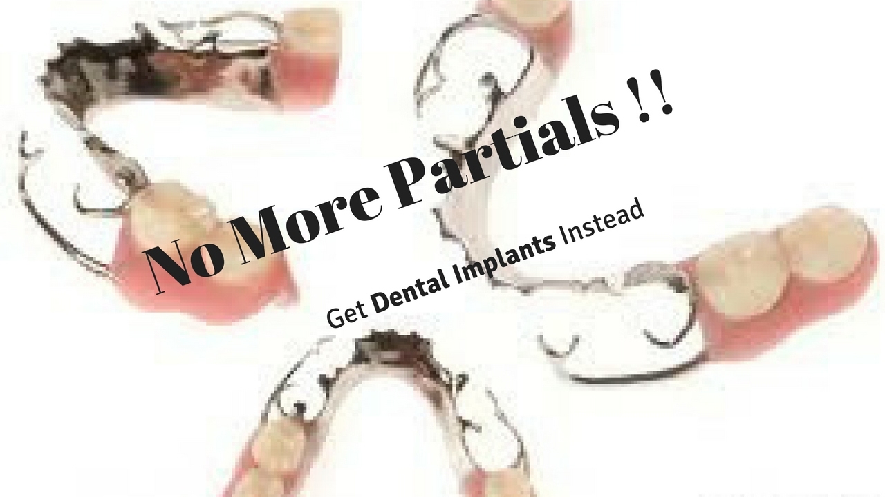 No more Partial Dentures, get  dental implants instead