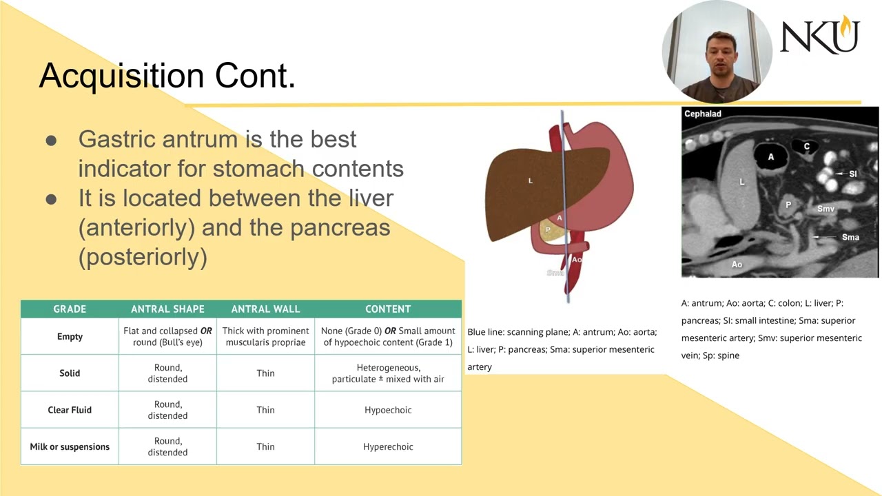 Gastric Pocus powerpoint