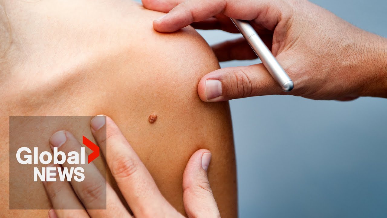 Melanoma is rising fast &mdash; So why are so many Canadians still skipping sunscreen?