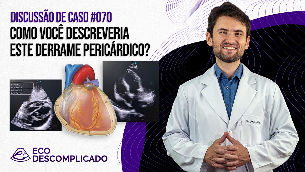 EcoDescomplicado - Discussão de caso #070 -  Como você descreveria este derrame pericárdico?
