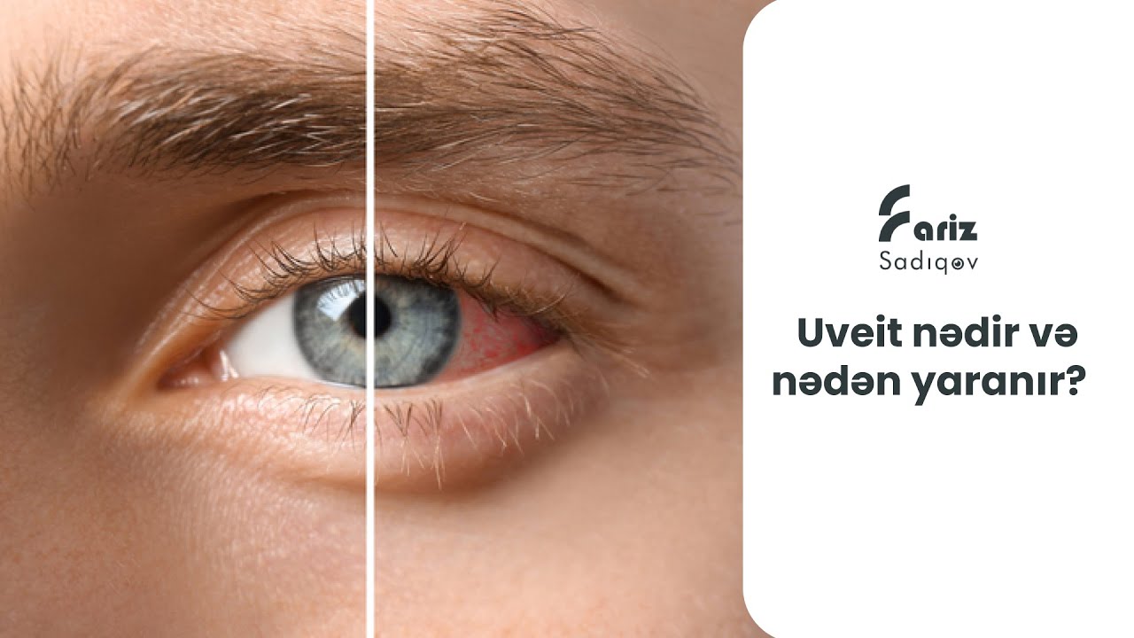 Uveit nədir və nədən yaranır? | 